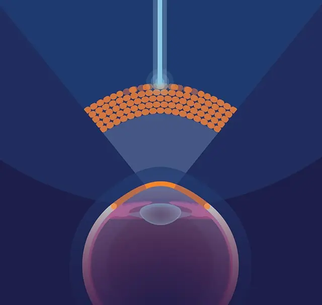 Lasik Laser in situ Keratomileusis