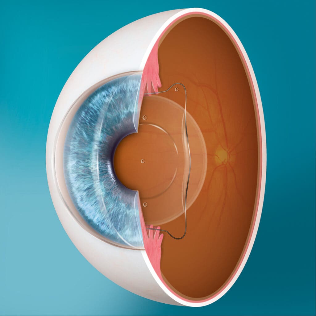 implantierbare Kontaktlinse ICL, Operative Korrektur von Fehlsichtigkeiten, Operative Korrektur für besseres Sehen