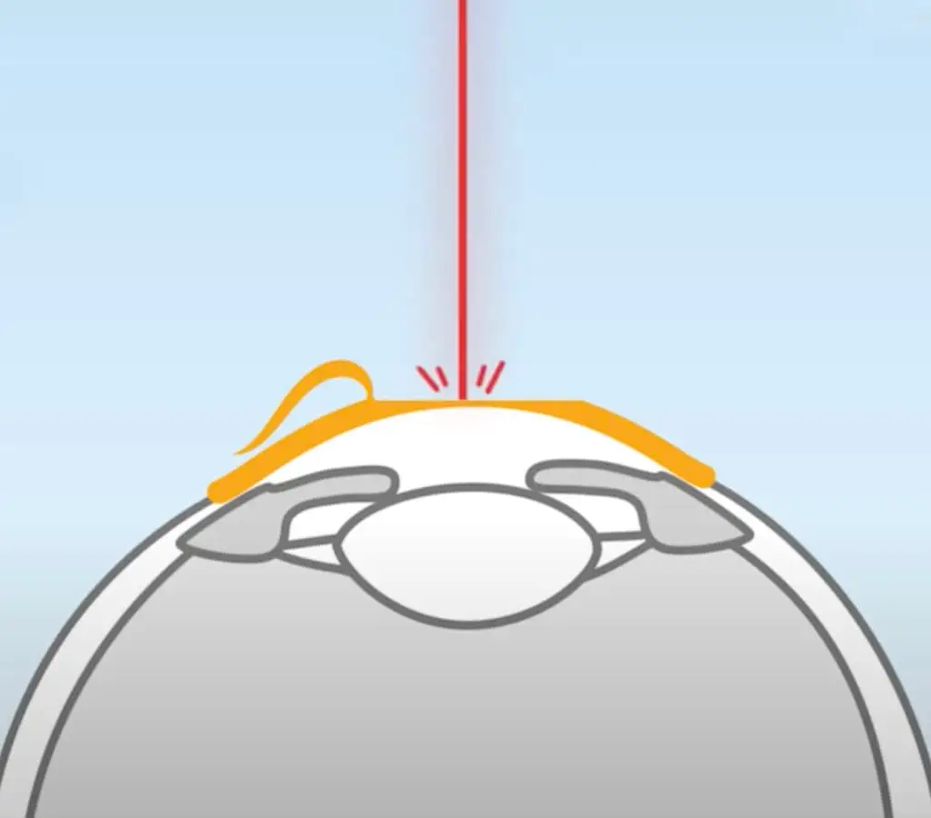 femto lasik